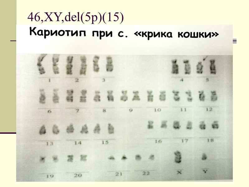 Снд Хиршхорна –Вольфа 46,XX,del(4p)  Делеция короткого плеча 4 хромосомы